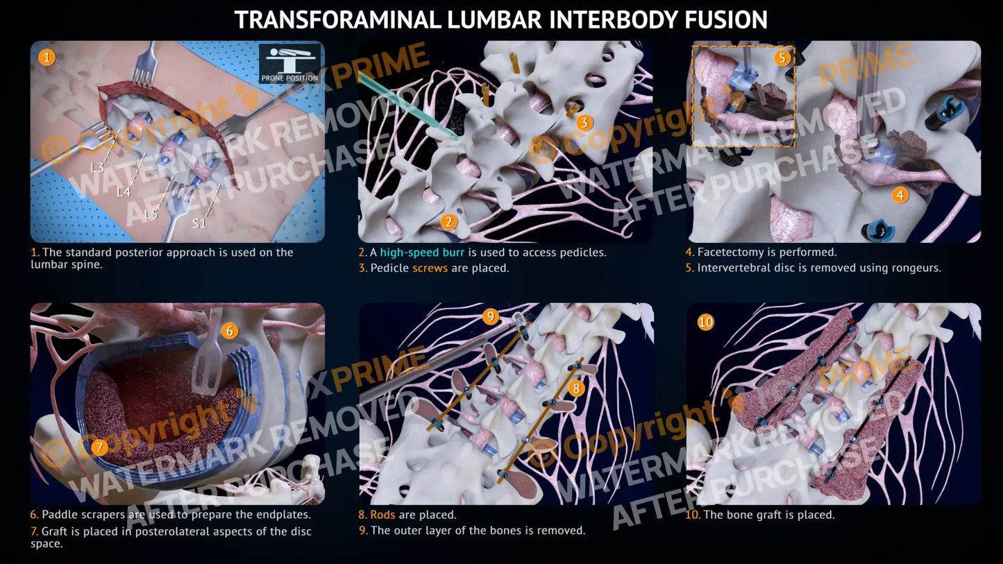 Transforaminal Lumbar Interbody Fusion L3-S1 Single Use / Light Still Shot